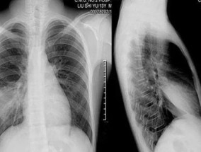 支原体肺炎咳嗽会胸痛吗 支原体肺炎咳嗽胸口会疼吗