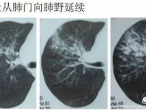 支原体肺炎对肺部有影响吗