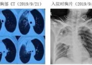 支原体肺炎会一直不好吗