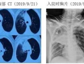 支原体肺炎会一直不好吗