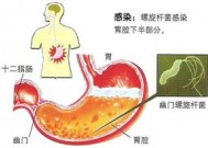 吃蔓越莓预防妇科病吗 儿茶素原华青素抑制幽门螺杆菌