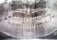 风水里说长了4颗智齿是什么命运 长了4颗智齿都要拔吗